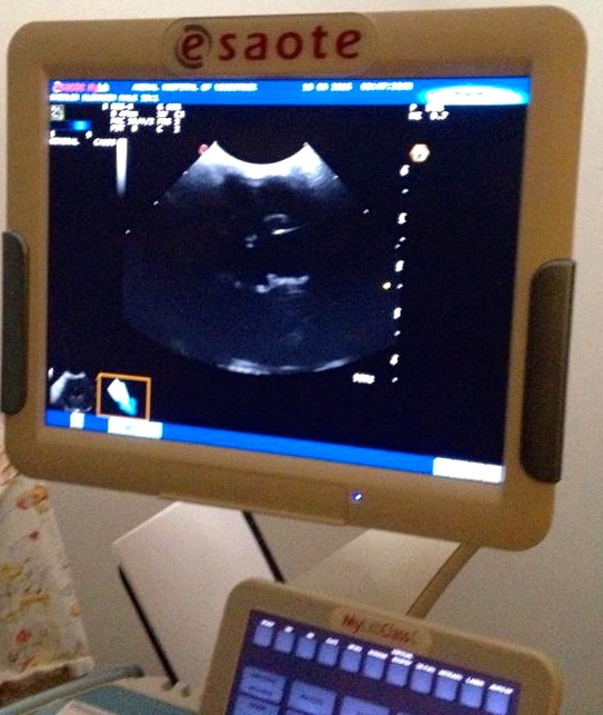 Tinys ultrasound