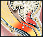 canine-brain-spaniel-syringomyelia-mp