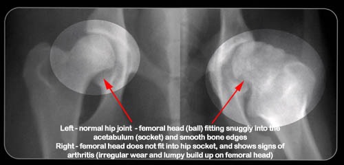 HIP DYSPLASIA1