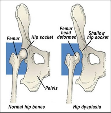 HIP DYSPLASIA2